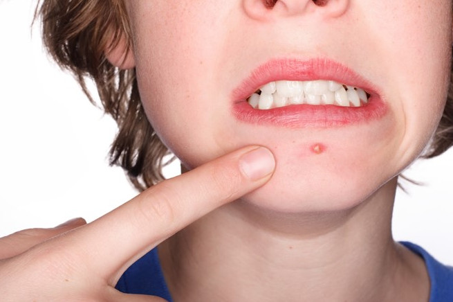 Picture 2 of Symptoms of 5 common skin diseases in the summer