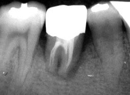 Picture 1 of Take stem cells from wisdom teeth