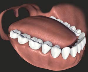 Picture 1 of Teeth misalignment, how treatment?