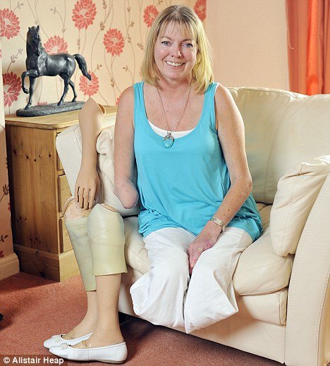 Picture 1 of Terrifying culprits cause many people to lose their legs, losing hands for 1 week