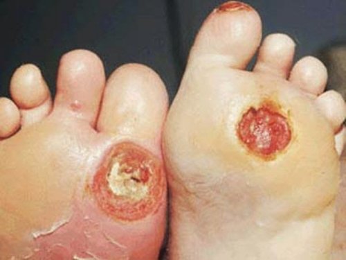 Picture 2 of Terrifying culprits cause many people to lose their legs, losing hands for 1 week