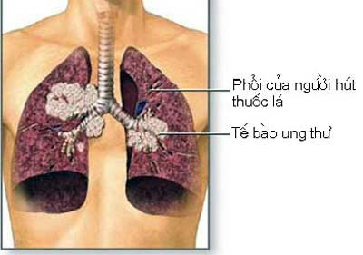 Picture 1 of Testing for lung cancer warning in smokers