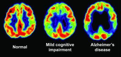 Picture 1 of Testing memory and PET scans helps detect early signs of dementia