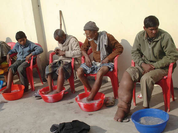 Picture 3 of The 20 most unusual and rare diseases in the world
