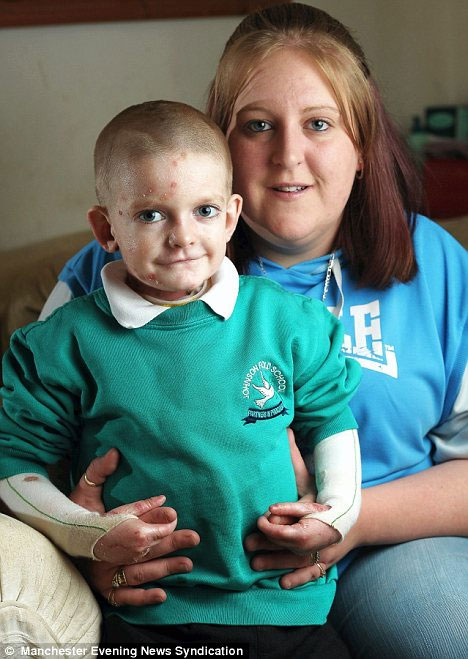 Picture 1 of The 6-year-old boy always suffered from blistering skin