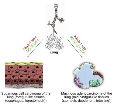 Picture 3 of The abnormality of cancer: When the lungs turn into stomach and intestines
