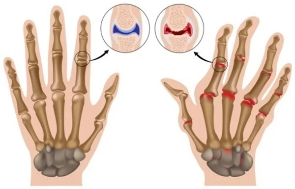 Picture 1 of The arthritic gene helped the ancient people survive the Ice Age