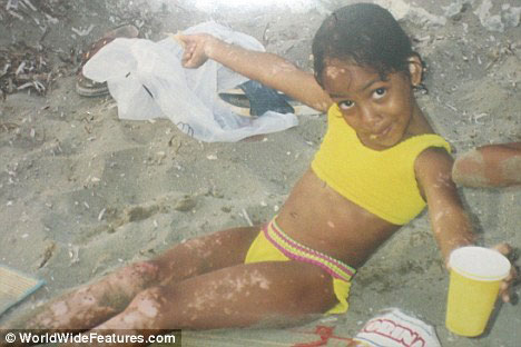 Picture 2 of The black girl turned into white because of vitiligo