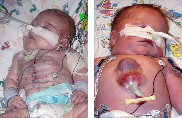 Picture 1 of The boy has a heart outside his body