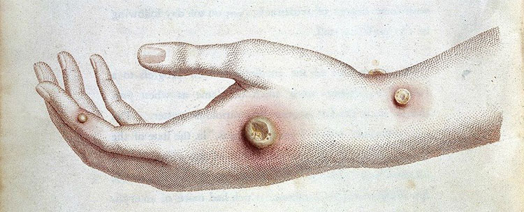 Picture 1 of The boy suddenly suffers from a strange, extinct disease from the 18th century