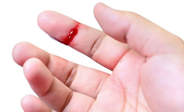 Picture 1 of The cause of a person suffering from hemophilia