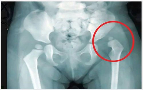 Picture 2 of The cause of hip joint pain