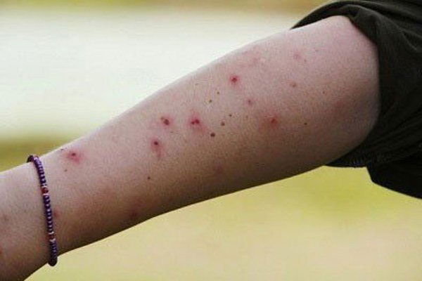 Picture 2 of The cause of hives is not well known