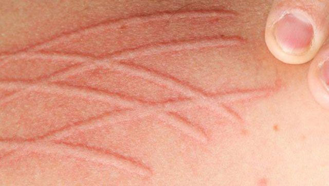 Picture 3 of The cause of hives is not well known