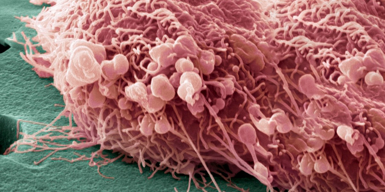 Picture 1 of The cause of metastatic cancer cells has been found