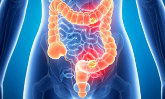 Picture 1 of The cause of young people with bowel cancer is 4 times higher than the previous generation