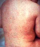 Picture 1 of The changing environment makes the disease increase