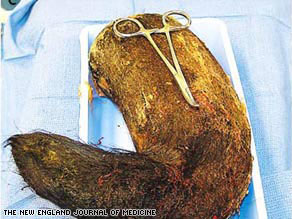 Picture 1 of The chignon weighing nearly 5 kg lives in ... stomach