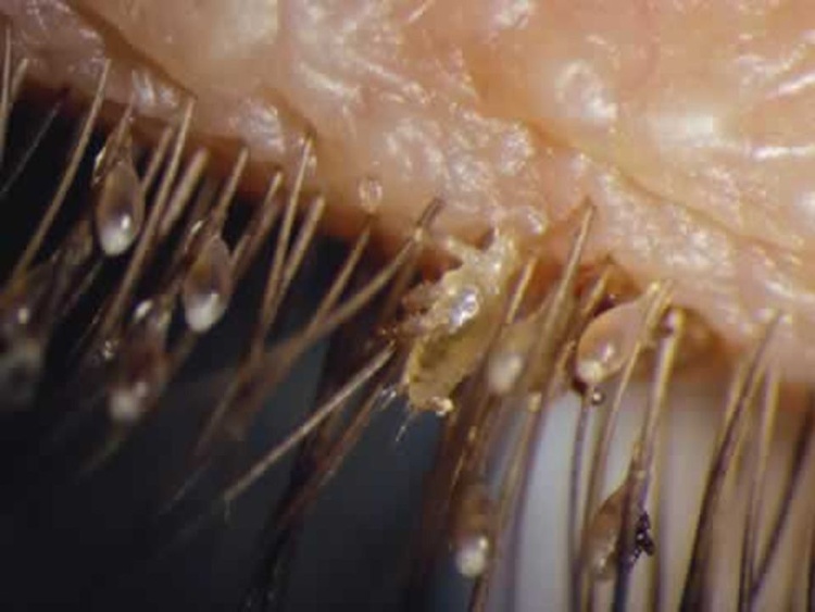 Picture 2 of The cure for pubic lice is simple and cheap