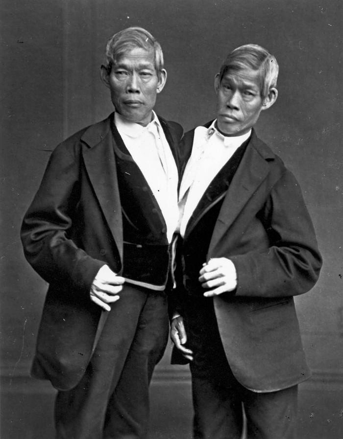 Picture 1 of The curious life of conjoined twins 200 years ago