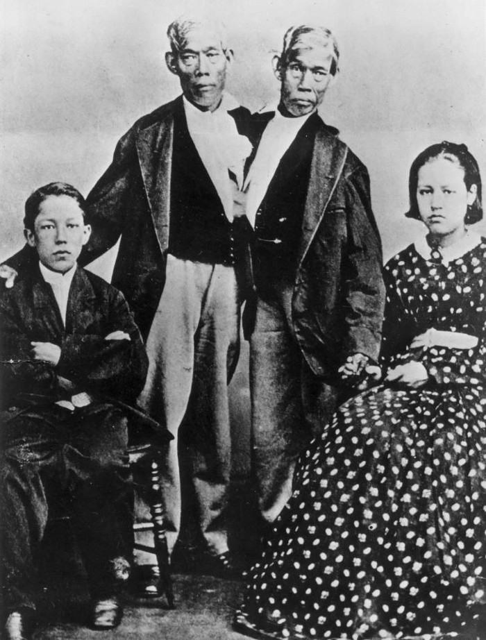 Picture 2 of The curious life of conjoined twins 200 years ago