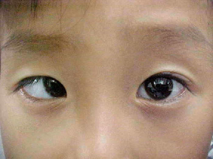 Picture 2 of The danger of astigmatism is not well known