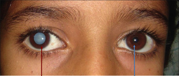 Picture 4 of The danger of astigmatism is not well known