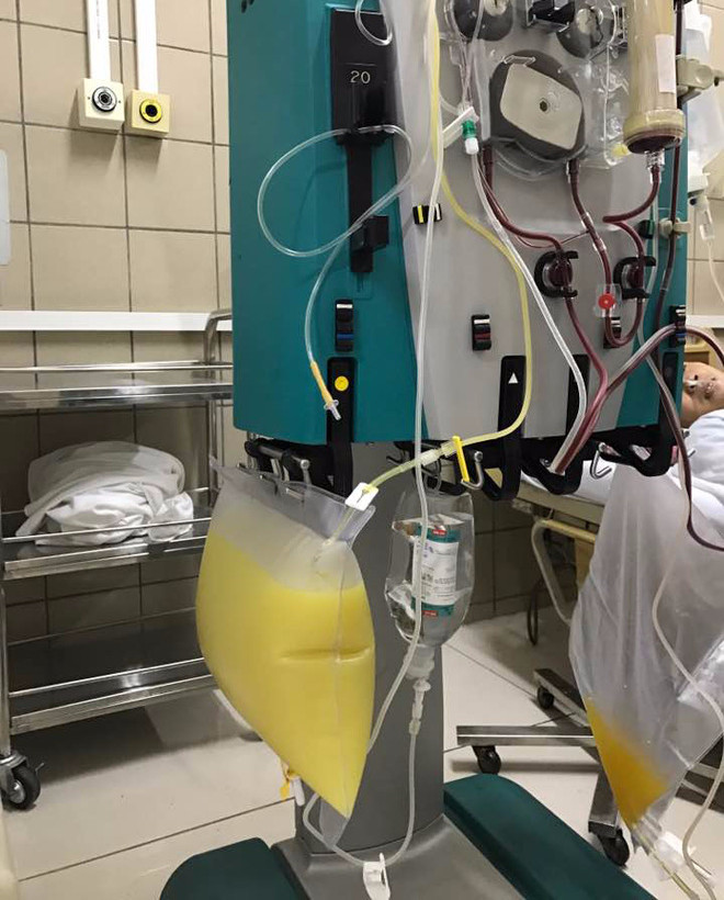 Picture 1 of The dangerous disease made blood fat yellow like chicken fat because of the delicious food