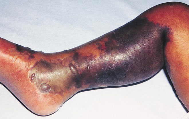 Picture 3 of The deadly bacteria in this day can explode when antibiotic resistance comes