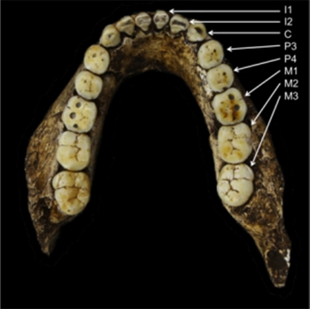 Picture 2 of The evolution of humanity will make wisdom teeth disappear