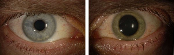 Picture 3 of The eye changes color after curing Ebola