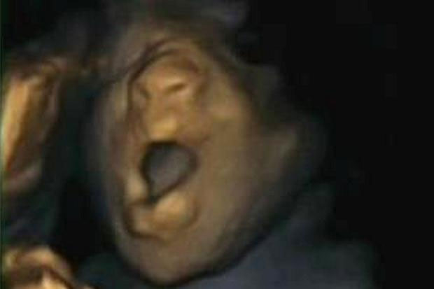 Picture 1 of The fetus also knows how to yawn