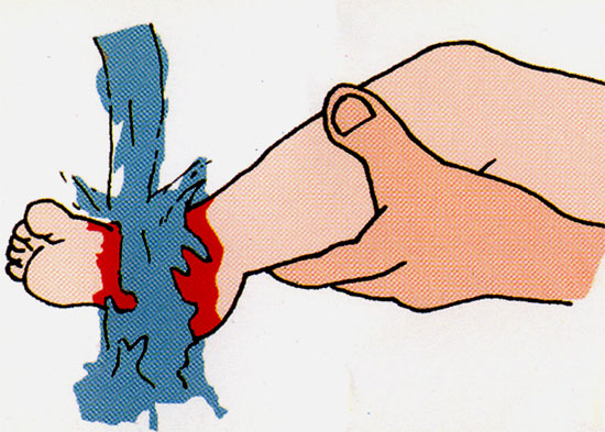 Picture 4 of The first aid for burns