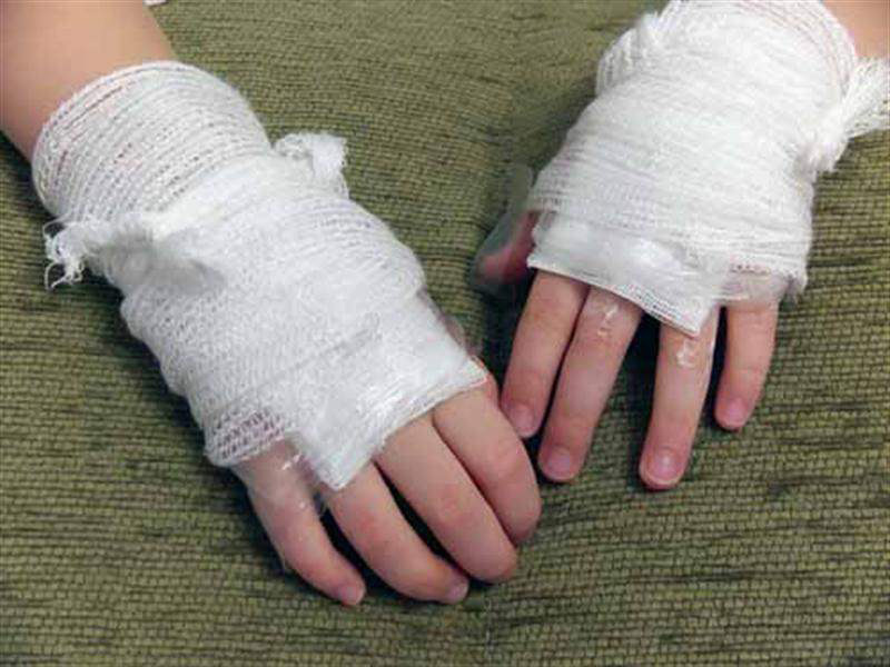 Picture 5 of The first aid for burns