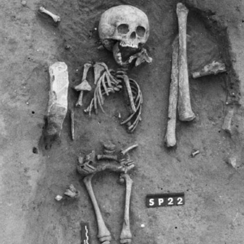 Picture 1 of The first case of Down syndrome in human history