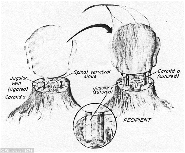 Picture 4 of The first head transplant surgery in history