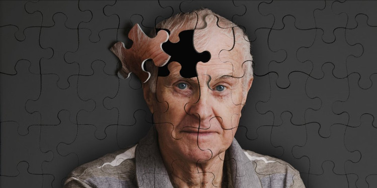 Picture 1 of The first patient brought a long-lived HIV virus to Alzheimer's