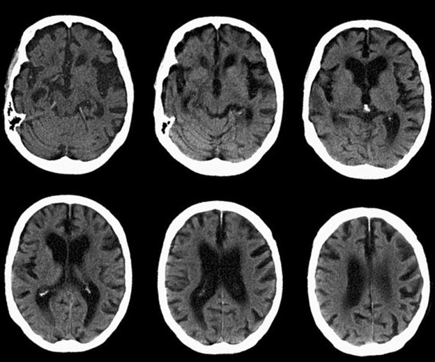 Picture 2 of The first patient brought a long-lived HIV virus to Alzheimer's