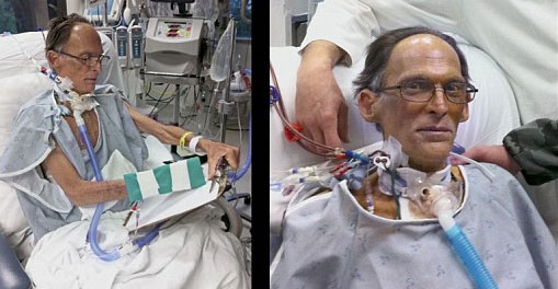 Picture 1 of The first person to live without a heartbeat