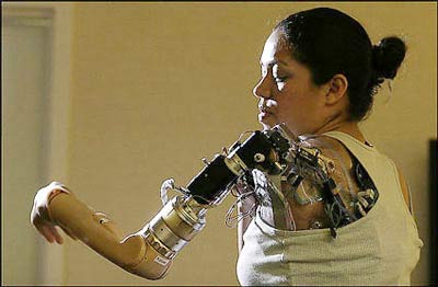 The first woman to have a biological arm images 1