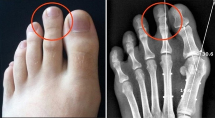 Picture 2 of The forefinger is longer than the big toe and the end only 15% of the world's population suffers