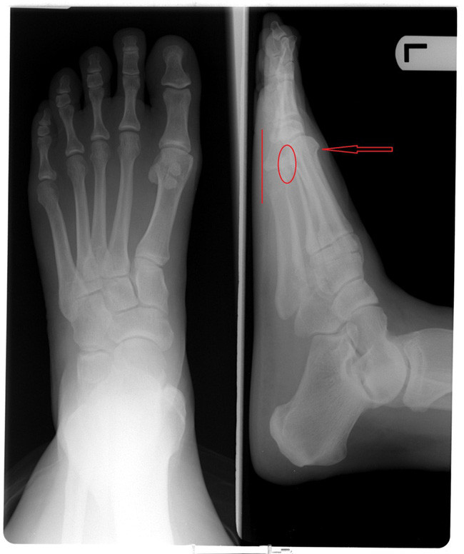 Picture 3 of The forefinger is longer than the big toe and the end only 15% of the world's population suffers