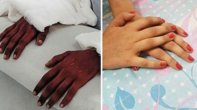 Picture 1 of The girl was hand grafted from black young man, 2 years after the miracle happened