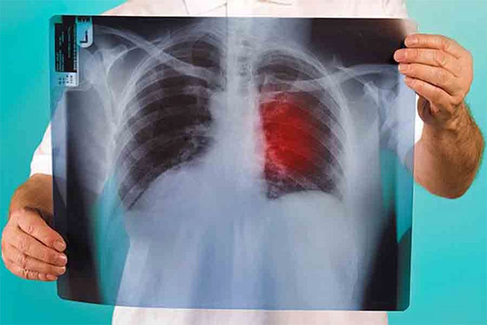 The groundbreaking method takes the lungs out of the body to 'clean' the cancer images 1