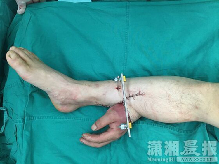 Picture 1 of The implant has a hand that is nourished on the leg