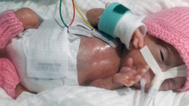 Picture 1 of The lightest baby born in the world