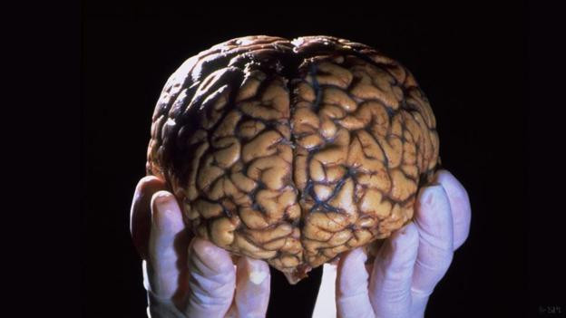 Picture 3 of The man 'no brain' still lives challenging the scientific world