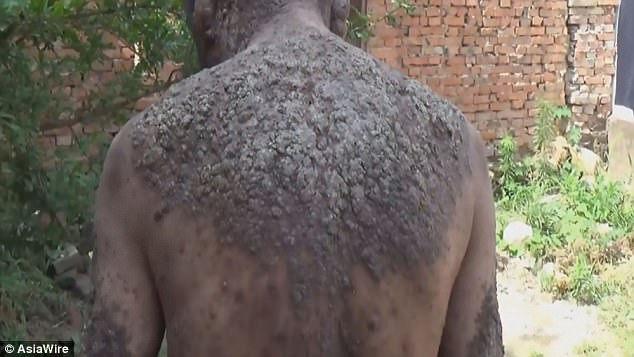 Picture 1 of The man was driven away by the whole village because of the skin like a tree trunk