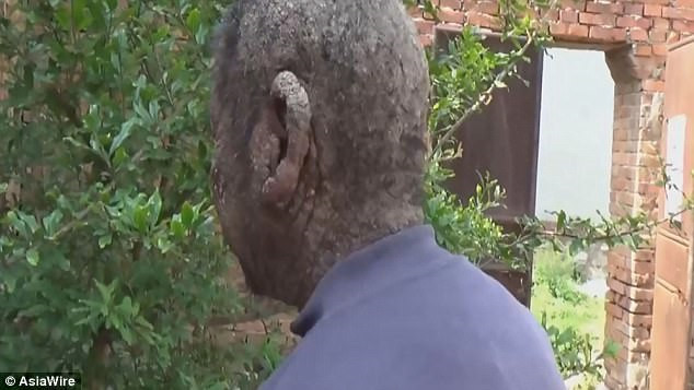 Picture 2 of The man was driven away by the whole village because of the skin like a tree trunk