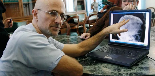 Picture 2 of The man who is about to have a head transplant surgery: